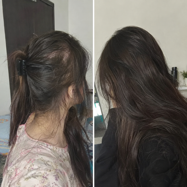 Hairfall